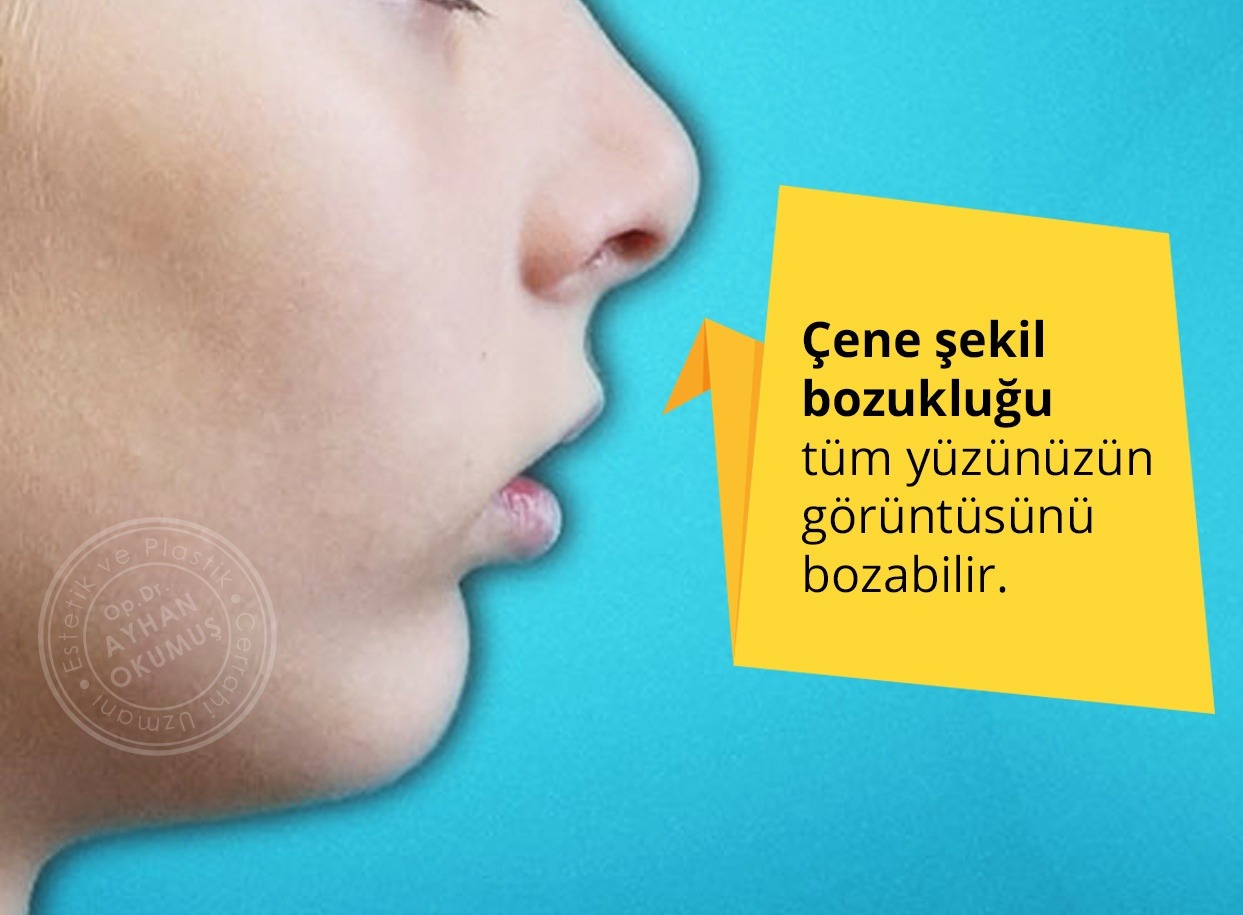 Çene Şekil Bozukluğu